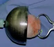 Illustration of arthroplasty with tibial bone - Dr. Mohammed Hutaif