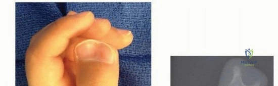 صورة توضيحية لـ التحام العظم الزورقي والكعبي: فهم شامل لأسباب وعلاج القدم المسطحة المؤلمة مع الأستاذ الدكتور محمد هطيف