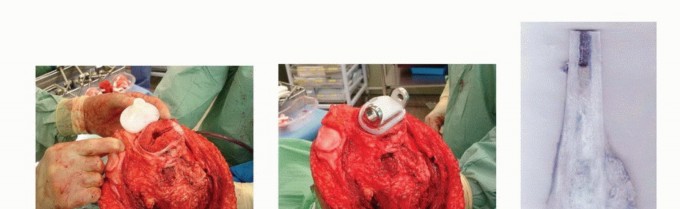 صورة طبية: الأطراف الصناعية القابلة للتمدد للأطفال: دليل شامل للمرضى حول الوقاية من العدوى والعلاج في صنعاء مع الأستاذ الدكتور محمد هطيف