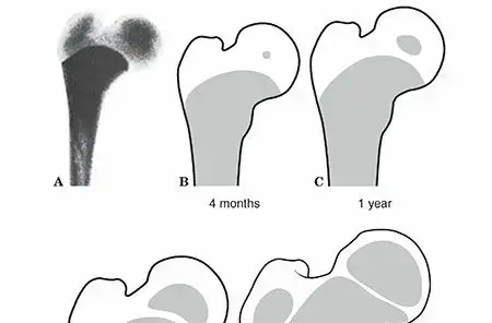 كسور وخلوع مفصل الورك عند الأطفال: دليلك الشامل لرعاية طفلك مع الأستاذ الدكتور محمد هطيف