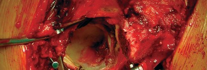 مفصل ورك سليم ومفصل مصاب بالتهاب المفاصل