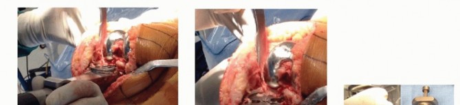 Illustration 6 for Removal of Well-fixed Components: Safe Techniques for Revision TKA