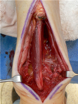 Illustration 40 for First Metatarsal Surgery: Expert Solutions for Foot & Ankle Pain