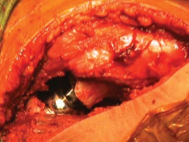 Illustration 23 for Unlock Movement: Arthroplasty for Bony Ankylosis Solutions