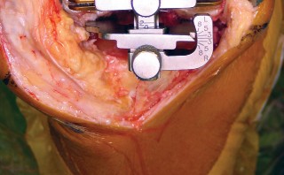 Illustration 24 for Minimize Pain, Maximize Recovery: TKA with Parapatellar