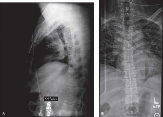 Illustration 12 for Spondylodiscitis: Deciphering the next course of action