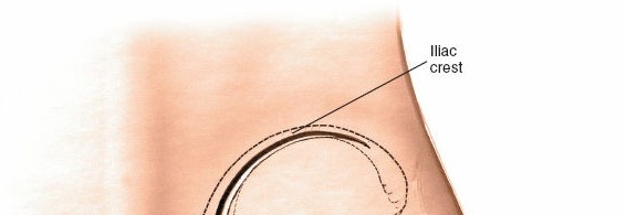 Simple & Safe Posterior Approach to the Sacroiliac: Key Techniques