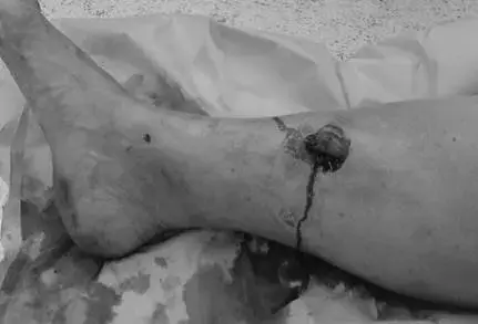 صورة توضيحية لـ علاج كسور الساق والقدم المعقدة | د. محمد هطيف