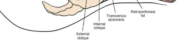 Illustration of anterolateral retroperitoneal approach - Dr. Mohammed Hutaif