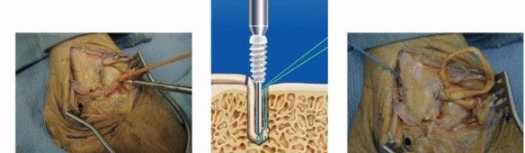 Illustration 20 for Lateral Ankle Repair: Maximize Stability with Interference Screw Fixation