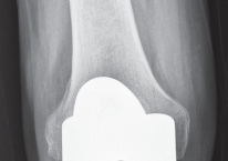 Illustration 35 for Minimize Pain, Maximize Recovery: TKA with Parapatellar
