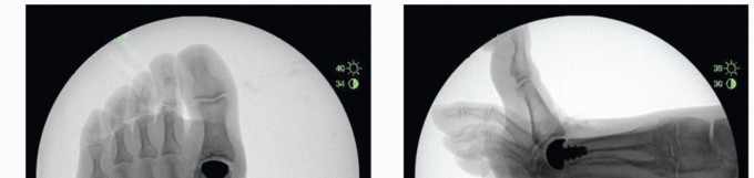 Illustration 51 for End Articular Cartilage Loss: Arthrosurface HemiCAP Resurfacing