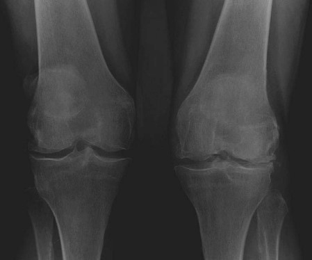 Optimizing TKR in Valgus: Expert Strategies for Complex Cases