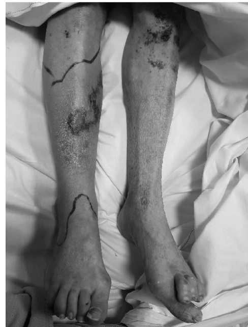 Managing a Post-ORIF Infected Ankle Case: Insights & Strategies