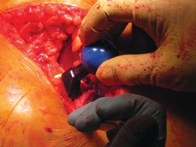 صورة طبية: تقنية الجذع القصير لاستبدال مفصل الورك الكلي: نهج الأستاذ الدكتور محمد هطيف لتدخل جراحي أقل ونتائج أفضل