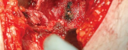 Illustration 45 for Unlock the Figure Posterior Approach to the Hip