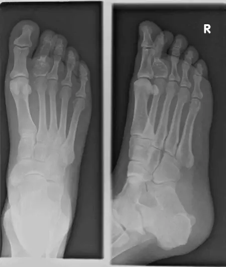صورة توضيحية لـ الورم الغضروفي الداخلي (Enchondroma): دليل شامل للمرضى مع الأستاذ الدكتور محمد هطيف في صنعاء