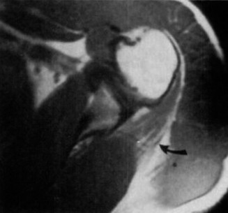 Illustration 38 for Right Shoulder Pain? Avoid This Common X-ray Mistake.