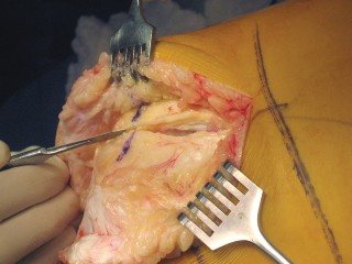 Illustration 12 for Posterior Stabilized Technique: Essential Insights for TKA Success