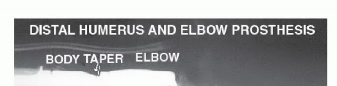 صورة طبية: استئصال الجزء البعيد من عظم العضد: تقنيات آمنة للحفاظ على الطرف في صنعاء مع الأستاذ الدكتور محمد هطيف
