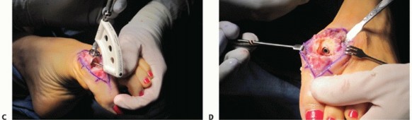 Illustration 35 for End Articular Cartilage Loss: Arthrosurface HemiCAP Resurfacing