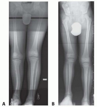 Limb Lengthening Using the Ilizarov & Monoplanar Methods: A Guide