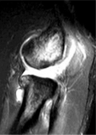 Illustration 75 for Right Shoulder Pain? Avoid This Common X-ray Mistake.