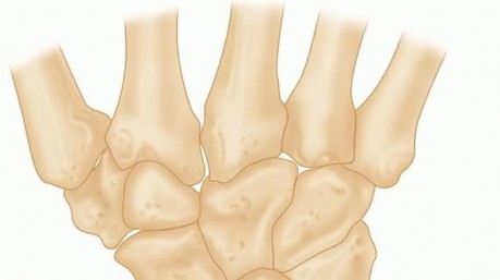 Osteotomy of the Radius for Treatment of Kienböck Disease