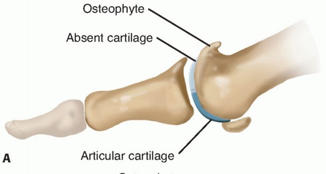 End Articular Cartilage Loss: Arthrosurface HemiCAP Resurfacing