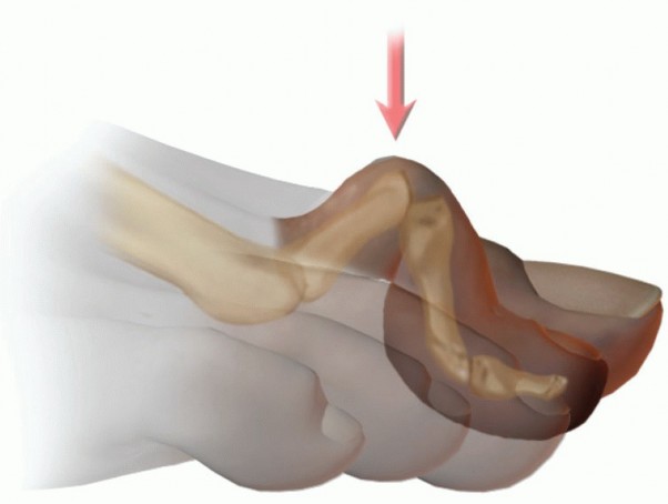 Hammer Toe Correction: Understanding the Extensor Digitorum Longus