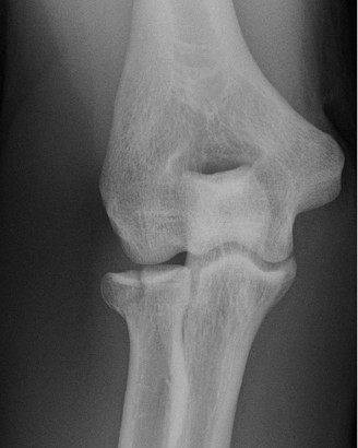 Illustration 61 for Right Shoulder Pain? Avoid This Common X-ray Mistake.
