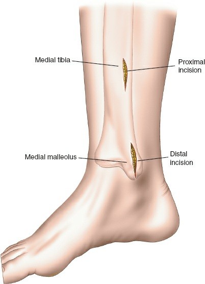 Illustration of distal tibia minimally - Dr. Mohammed Hutaif