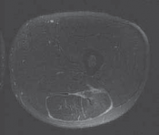 Proximal Hamstring Injuries: br j sports Insights for Faster Recovery