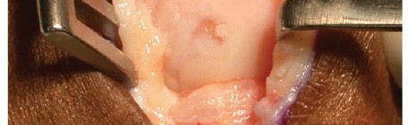 Illustration 5 for MTP Joint Arthrodesis: The Key to Optimal Toe Positioning