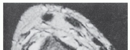 Illustration 9 for Beyond Primary Repair: Solutions for Peroneal Tendon Subluxation