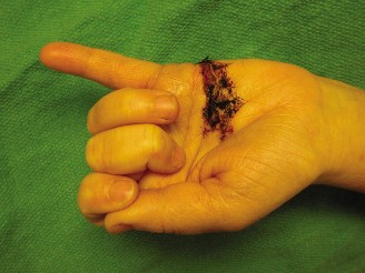 Mastering FDS and FDP Laceration Diagnosis: Case 18