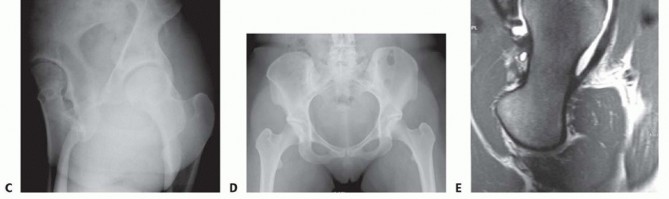 Illustration 2 for Proximal Femoral Osteotomy: When This Hip-Saving Surgery Is Performed