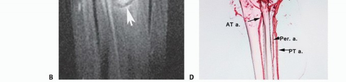 صورة توضيحية لـ استئصال ورم العضلة النعلية: دليل شامل لحماية عضلة الساق والتعافي الكامل في صنعاء مع الأستاذ الدكتور محمد هطيف