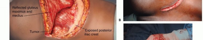 توضيح طبي: جراحة نقائل الحوض: حل شامل لآلام العظام واستعادة الحركة مع الأستاذ الدكتور محمد هطيف