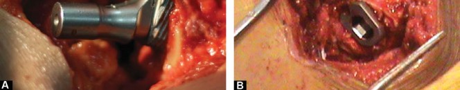 صورة طبية: مفصل الفخذ الصناعي قصير الجذع METHA: حلول مبتكرة للحفاظ على العظم في صنعاء مع الأستاذ الدكتور محمد هطيف