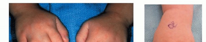 Release of Simple Syndactyly