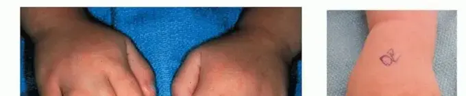 صورة توضيحية لـ فصل الأصابع الملتصقة (التصاق الأصابع) للأطفال والكبار: دليل شامل من الأستاذ الدكتور محمد هطيف