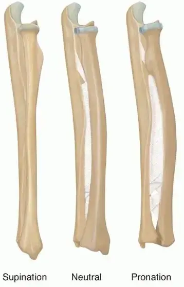 صورة توضيحية لـ تصحيح تشوه التئام عظام الساعد (الزند والكعبرة): دليل شامل للمرضى مع الأستاذ الدكتور محمد هطيف