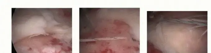 صورة توضيحية لـ تمزق الكفة المدورة: دليل شامل للمريض لاستعادة قوة كتفك وحركته