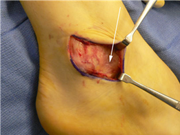 Illustration 18 for First Metatarsal Surgery: Expert Solutions for Foot & Ankle Pain