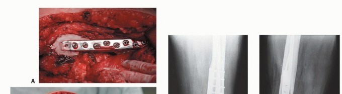 صورة طبية: النقائل العظمية الفخذية: دليل شامل للعلاج واستعادة الوظيفة مع الأستاذ الدكتور محمد هطيف في صنعاء