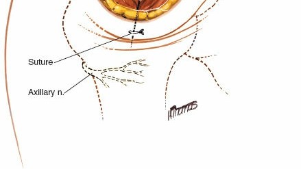 Illustration 96 for Essential Guide: Mastering Every Approach to the Shoulder