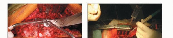 Illustration 16 for Total En Bloc Spondylectomy: Complete Resection for Spinal Tumors