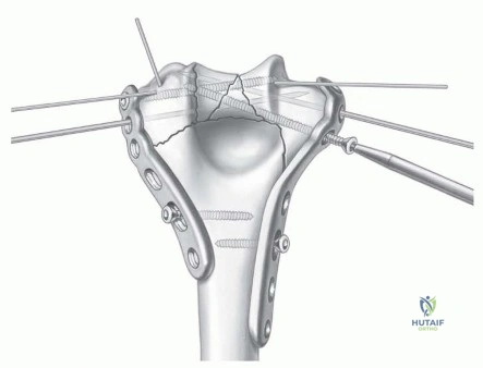 Illustration 10 for Optimizing ORIF for Distal Humerus: Prevent Class II HO