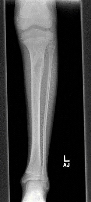 Ace Your Orthopaedic Oncology Structured Oral Exam: Non-Ossifying Fibroma